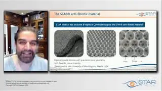 The MINIject Next Generation Supraciliary Device - Dr Ike K. Ahmed