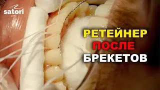 Retainer after removing braces
