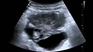 IDENTIFICAREA CANCERULUI OVARIAN SEROS DE GRAD INALT - EXAMINARE ECOGRAFICA CU ECOGRAFUL VINNO 8