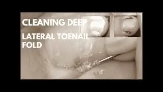 Cleaning Deep Lateral Toenail Fold.