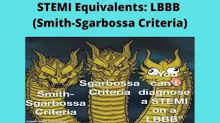 STEMI Equivalent: LBBB (Smith-Sgarbossa Criteria)