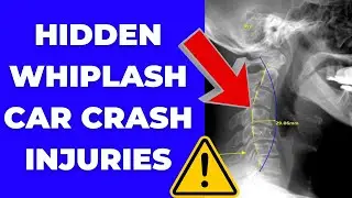 The Hidden Neck Injury After a Car Crash, WHIPLASH (Why X-Rays & MRIs Miss It!) | Dr. Gregory Kramer