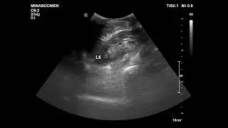 pleural fibrous tumor