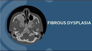 Fibrous Dysplasia