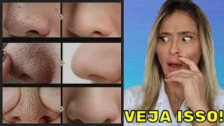 COMO TIRAR SEUS CRAVOS EM CASA DA FORMA CORRETA!