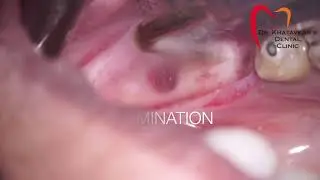 Ridge Split surgery & implant placement with the SurgicTouch Piezosurgery from Woodpecker