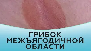 Грибок межъягодичной области