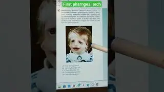 First pharyngeal arch syndrome 
