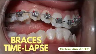😬Braces Before and after Time-lapse |Orthodontic treatment full video | your dentist #braces