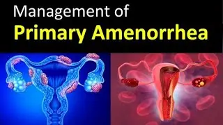 Management of Primary Amenorrhea