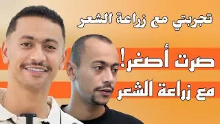 تجربة الممثل السعودي محمد عباس مع زراعة الشعر بعد 6 أشهر | تجربتي مع زراعة الشعر