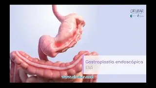 GASTROPLASTIA ENDOSCOPICA A TRAVES DEL PROGRAMA CIRUBAR BY CAIÑA & AGUILAR