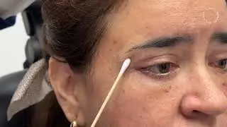 How would I look 2 weeks after my eyelid surgery?
