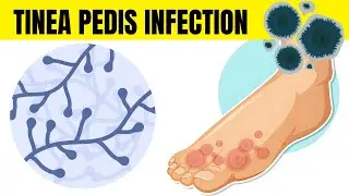 Tinea Pedis Infection (Athlete's Foot) - Causes, Types, Signs & Symptoms, And Treatment