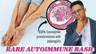 Eosinophils and lung disease:  Let’s talk EGPA, an eosinophilic vasculitis.