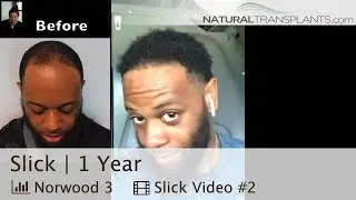 Hair Transplant Results Black Man at one year by Natural Transplants (Slick)