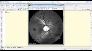 GLAUCOMA DETECTION USING ARTIFICIAL NEURAL NETWORKS||MATLAB Ieee Projects Bangalore