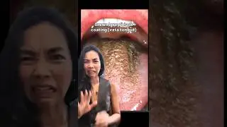 The truth about your tongue coating. What does it mean? #ayurveda #ayurvedaindonesia #holistichealth