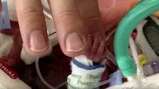 I medici trattengono il fiato quando vedono il bimbo per la prima volta.