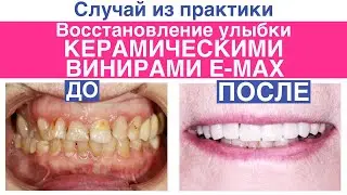 Восстановление красоты улыбки керамическими винирами E-max, восстановление зуба методом Build-up