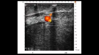 REQUEST Case 4: Ultrasound imaging of coronary target