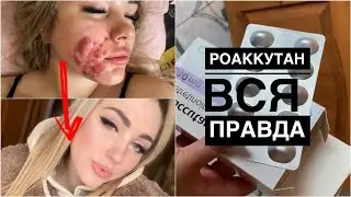 ПОЛ ГОДА ЛЕЧЕНИЯ АКНЕ РОАККУТАНОМ