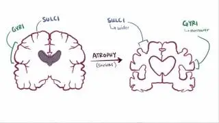 Alzheimer's: Best Crash Course