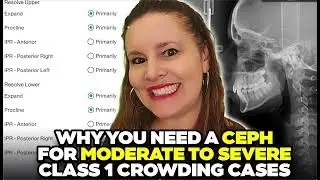 Why you DO need a CEPH still on  Moderate to Severe Invisalign Cases