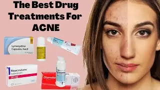 The Best ACNE Treatments | From DUAC to ROACCUTANE | HORMONAL vs BACTERIAL Acne