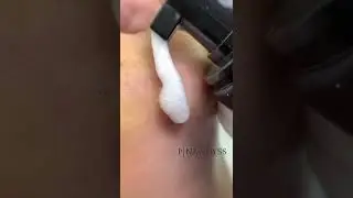 Мозоль 