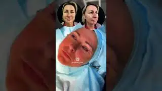 Как проходит операция пластики век #блефаропластика