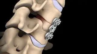 Discectomía Cervical Anterior y Fusión