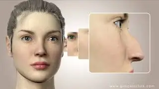 Rhinoplasty (Nose Surgery) Animated Video - Dr. Guncel Ozturk
