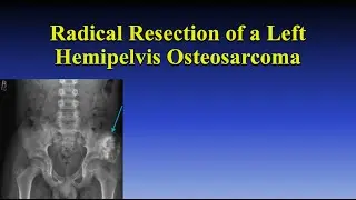 Radical Resection of a Left Hemipelvis Osteosarcoma