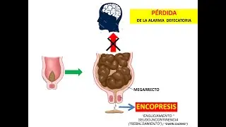 INCONTINENCIA FECAL / ENCONPRESIS