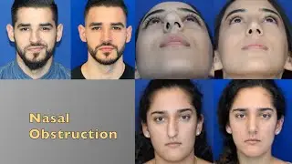 Reasons for Nasal Obstruction! Nose job before and after!
