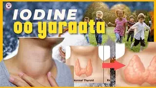 xanuunada ka dhalan kara yaraanshaha maadada Iodine xogocaafimaad