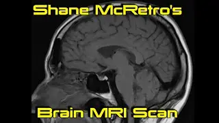 Shane's Brains! MRI Scan (No Contrast) - September 2023