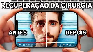 Simpatectomia 💦– Tudo sobre o Pós-Operatório e Recuperação!