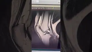 Видео МРТ где отсутствует передняя крестообразная связка и поврежден мениск . #массаж #доктор #юмор