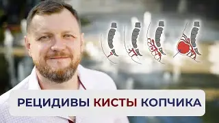 Рецидивы кисты копчика | ПРОКТОЛОГ ЕФИМ ХАРАБЕТ