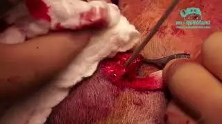 Tratamiento quirúrgico de fractura de craneo compleja