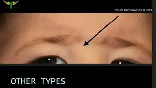 Dermoid cyst