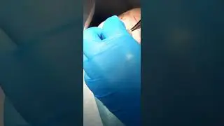 удаление пигментного невуса(родинки)