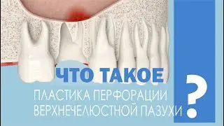 Пластика перфорации верхнечелюстной пазухи