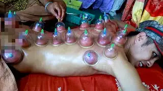 Thai CUPPING MASSAGE Therapy (PAINFUL)
