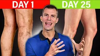 How To EASILY Get Rid Of Varicose Veins - Dr. Josh Axe