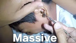 Removing One MASSIVE Earwax from Boy's Ear