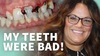 How to find the RIGHT dentist for amazing dental implants or full mouth rehab!