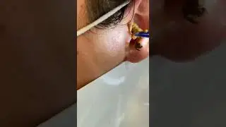 Black head removal on face - Blackheads on back treatment